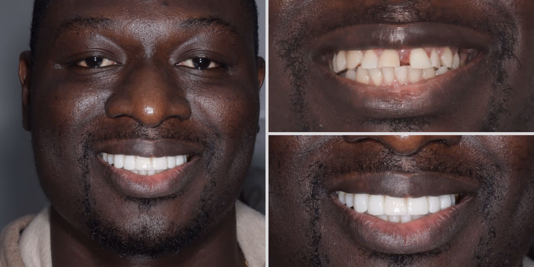Teeth straightening with invisalign and composite bonding