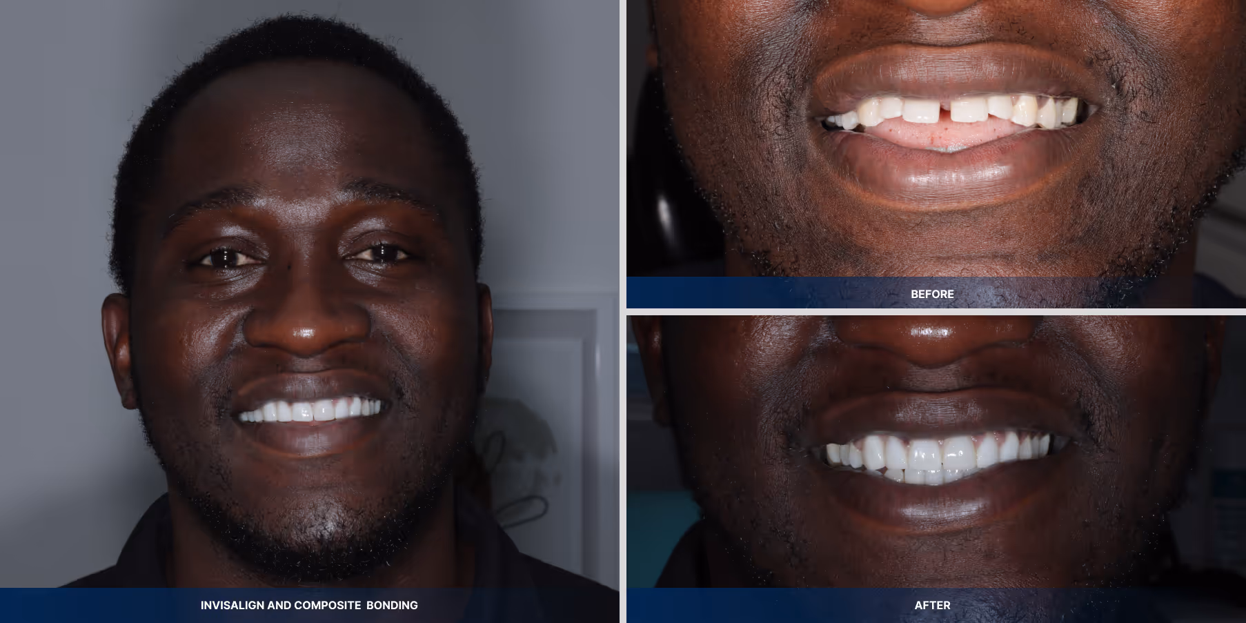 Invisalign and composite bonding