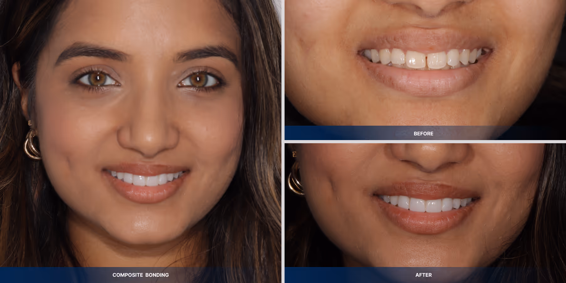 Composite bonding and whitening