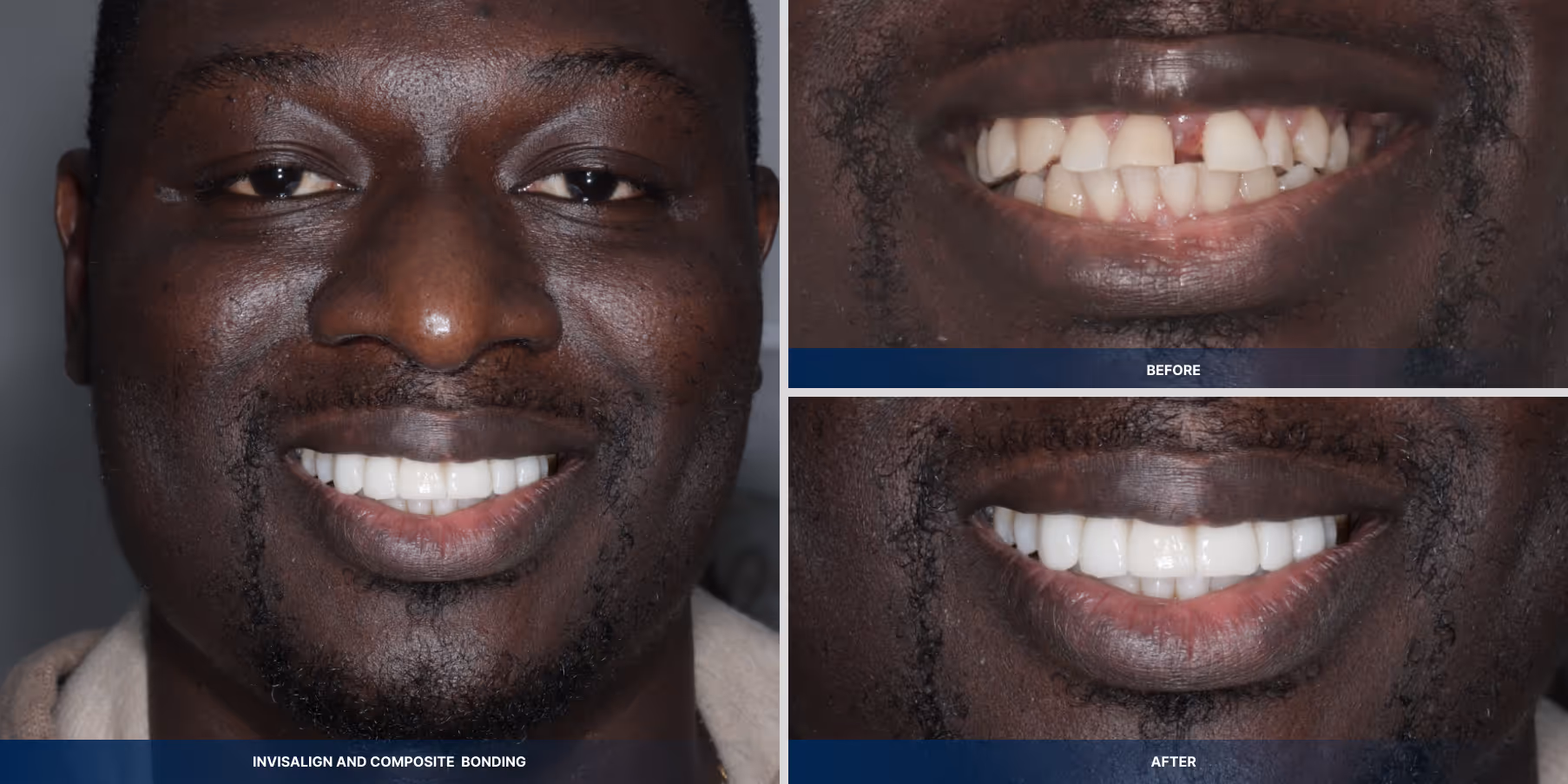 Teeth straightening and composite smile makeover