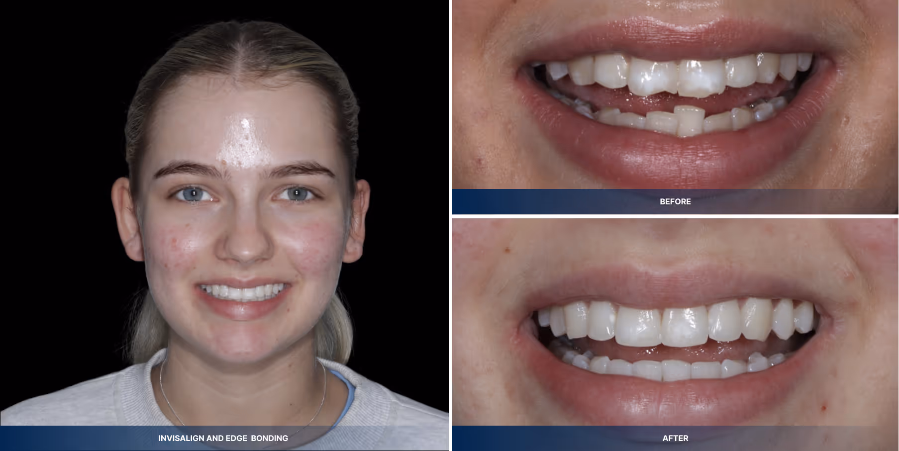 Invisalign and edge bonding
