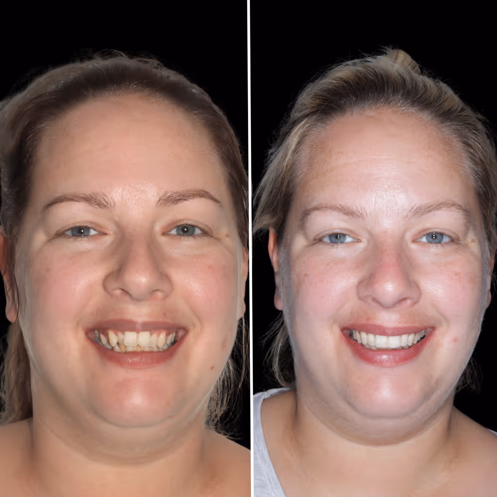 Invisalign before and after result