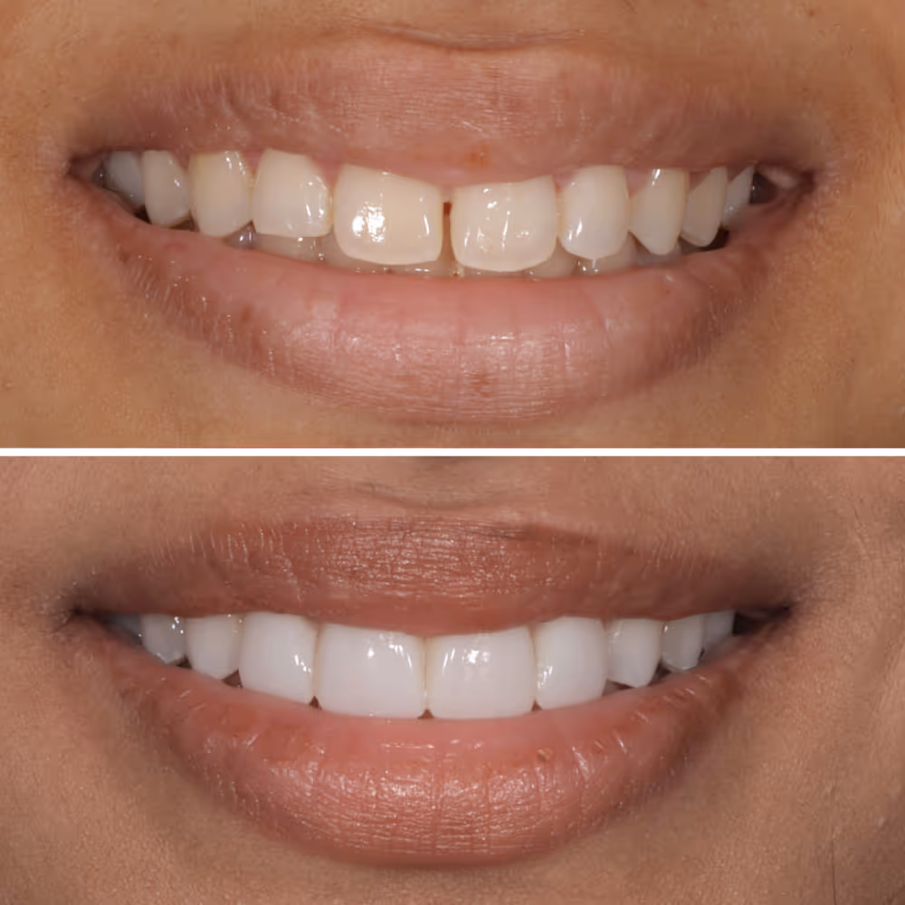 Composite Bonding