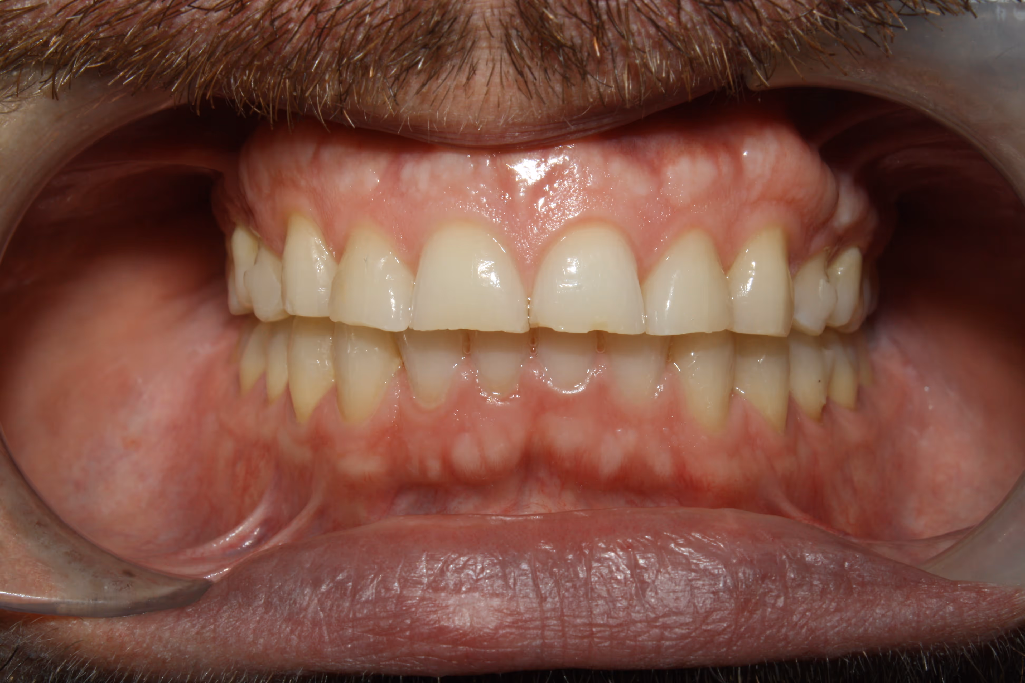 Tooth wear