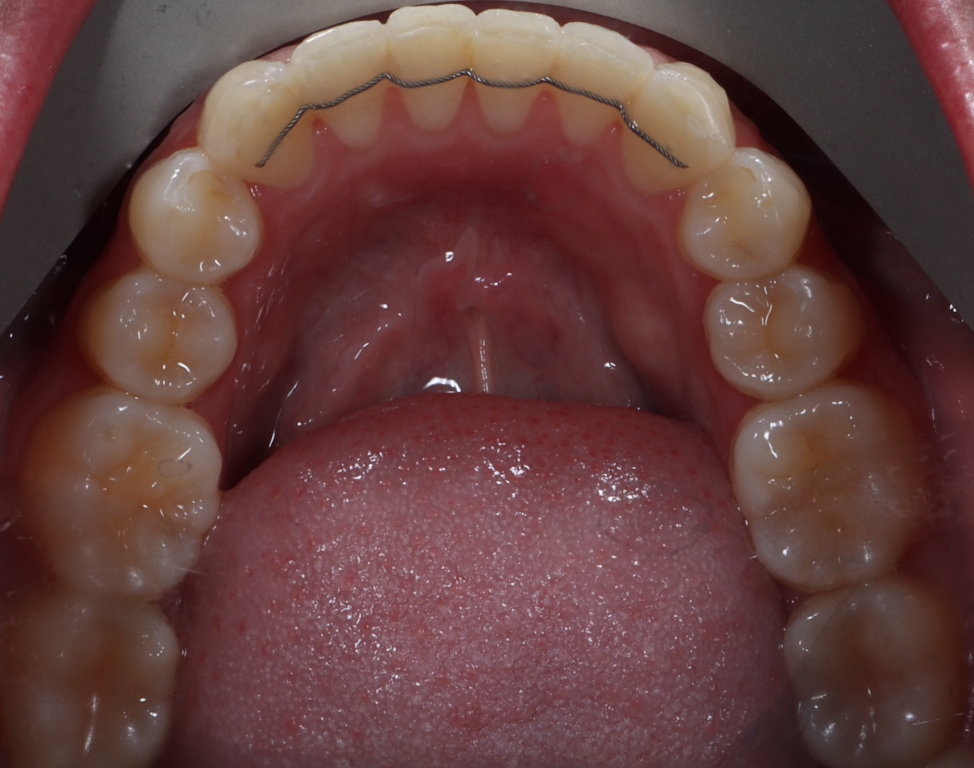 Bonded (fixed) retainer for bottom teeth