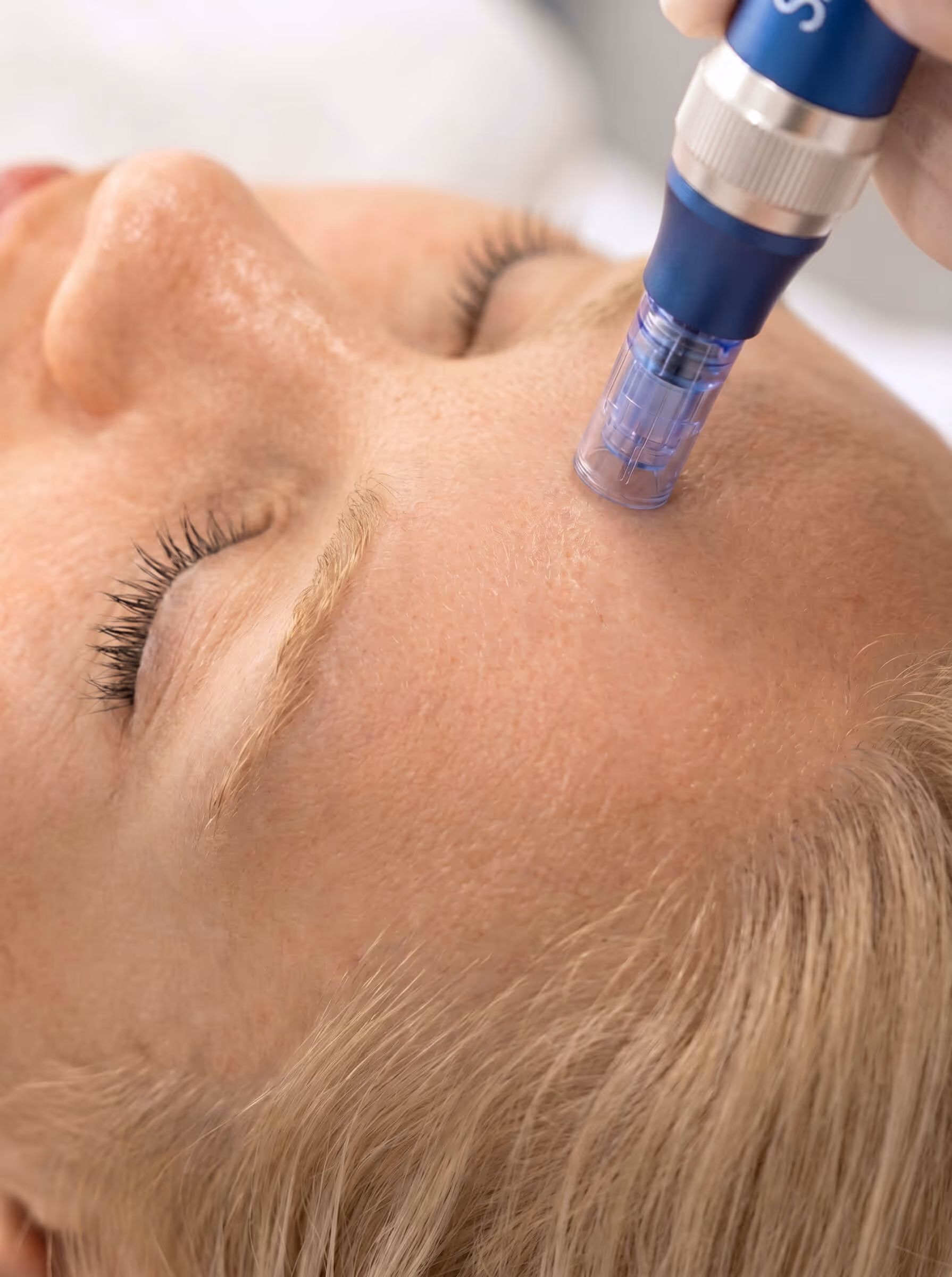 A blue electronic microneedling pen with a clear plastic tip is being applied to the center of the forehead to rejuvenate a plastikakademin patient's skin.