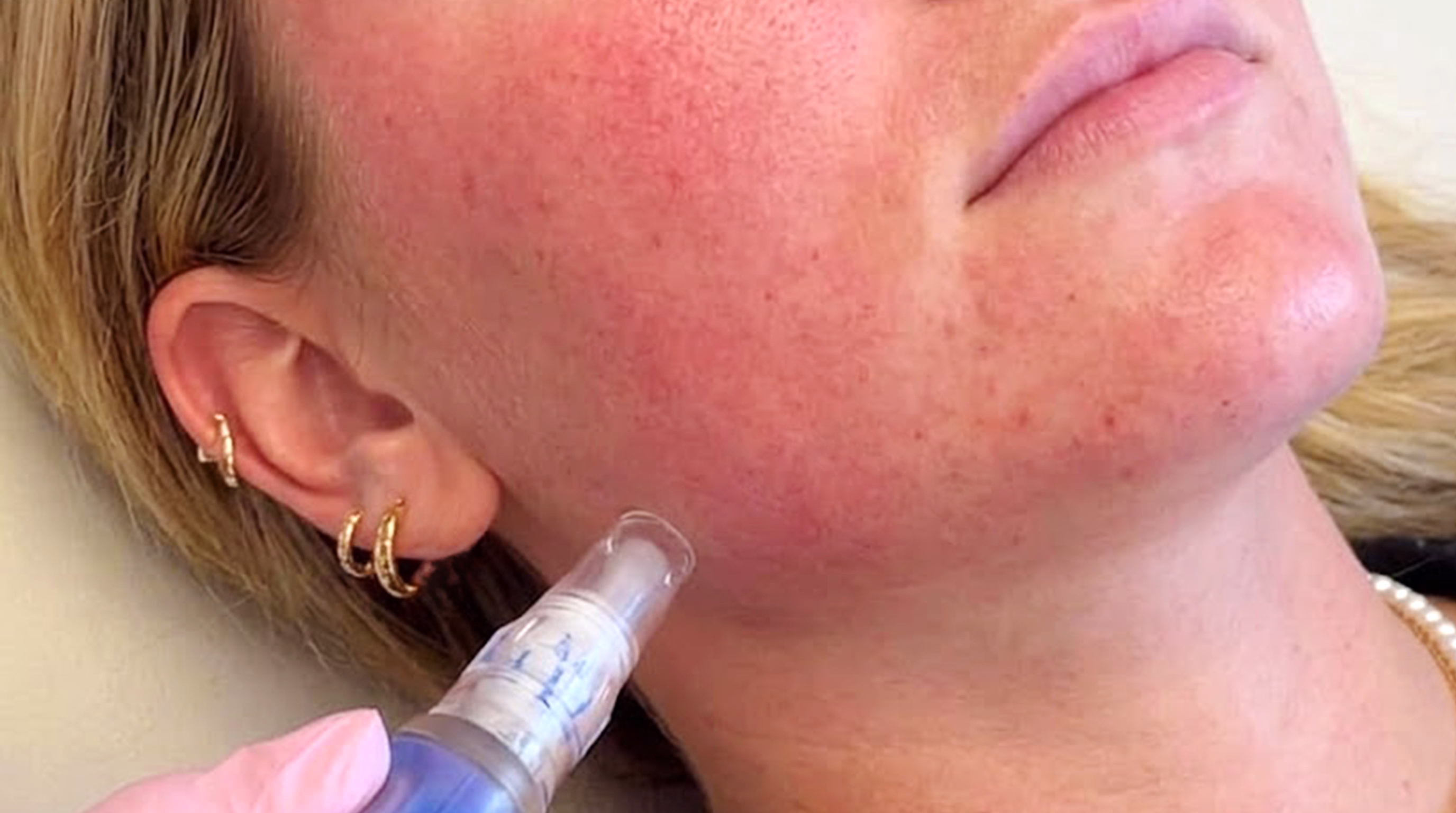 Microneedling utförs med sterila nålar i ett systematiskt mönster 