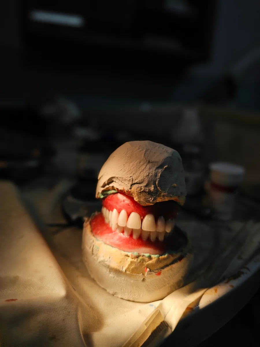 dentures-birmingham-al-custom-denture-set-on-plaster-model-in-lab