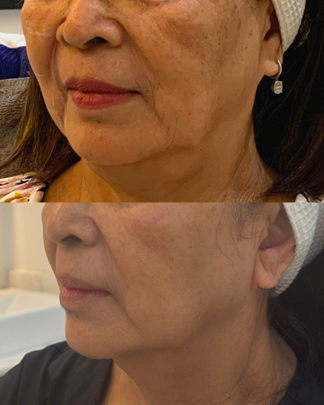 HIFU before-and-after jawline results eight weeks after one Ultraformer MPT session