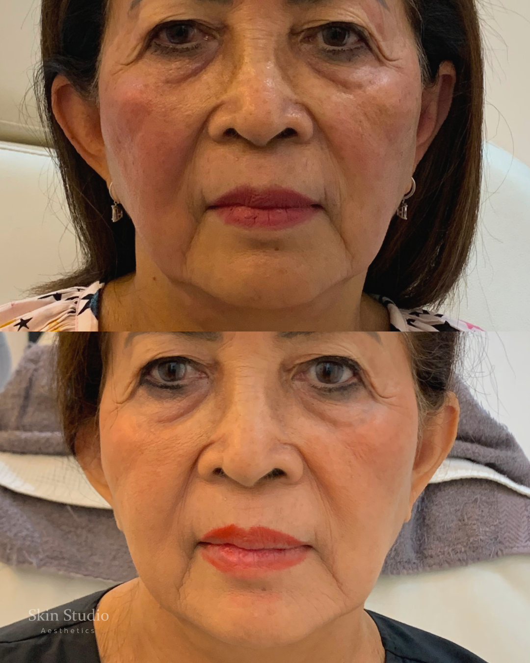 Full-face HIFU results eight weeks after one treatment at Skin Studio Bali