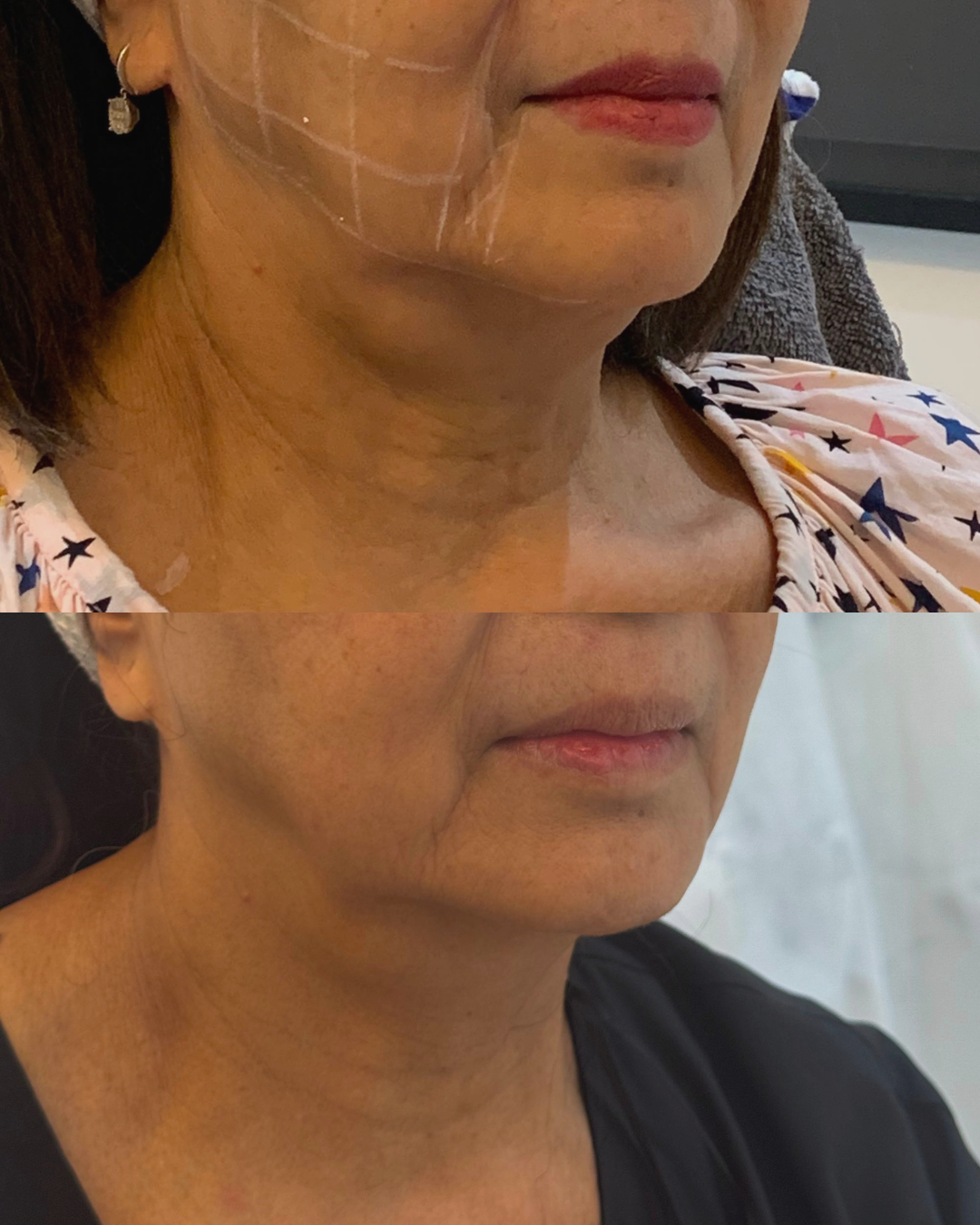 HIFU neck and jawline before-and-after results after one Ultraformer MPT treatment
