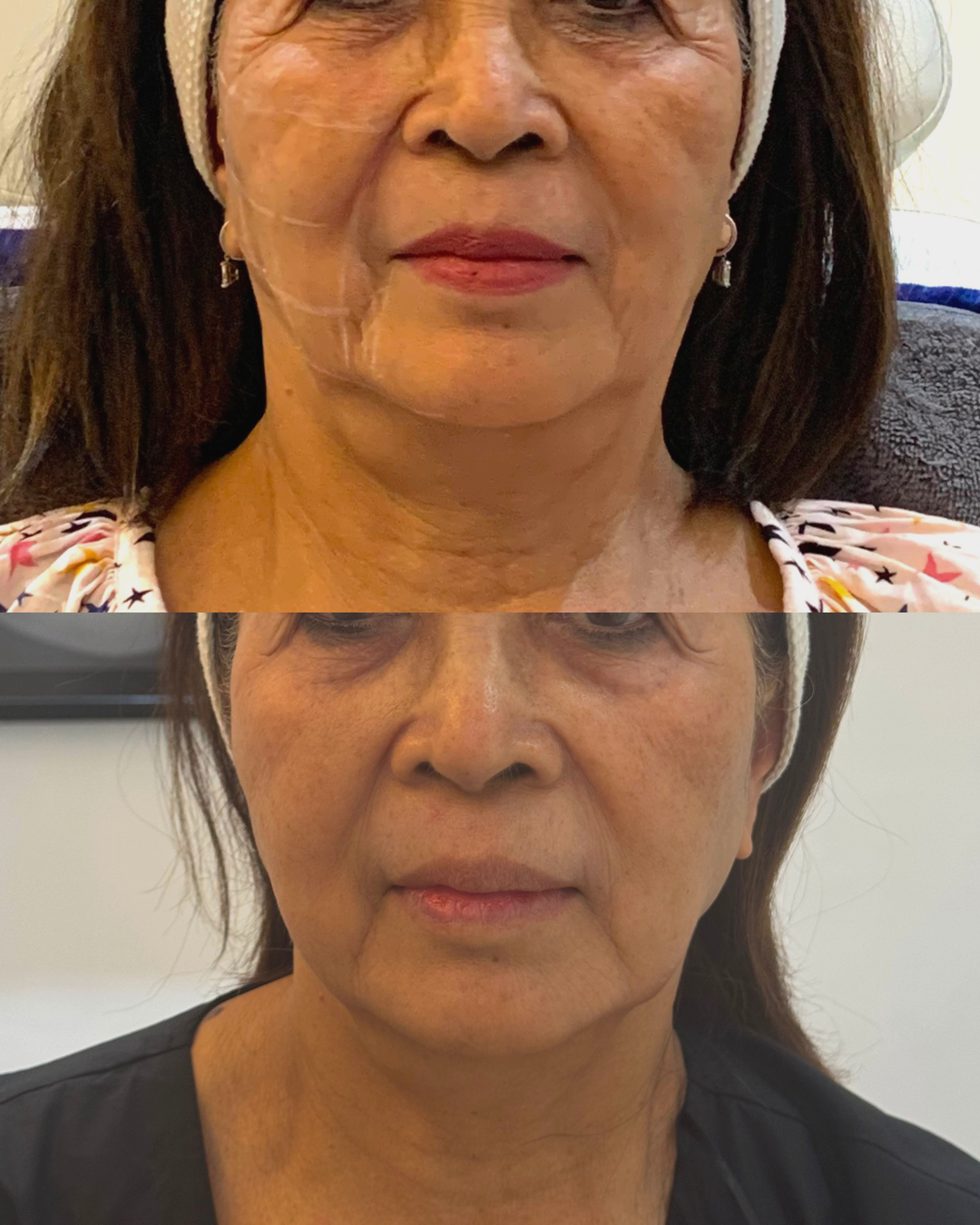Ultraformer MPT facial results eight weeks after one HIFU session