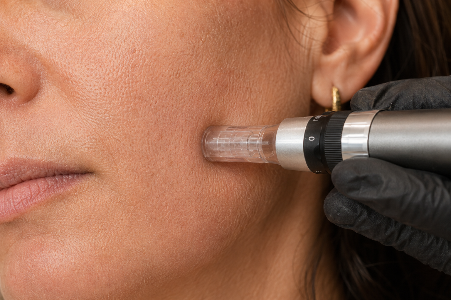 Professional skin assessment before microneedling treatment at Skin Studio Bali