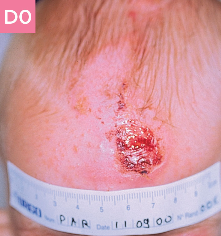 Small child with head wound before using UrgoTul
