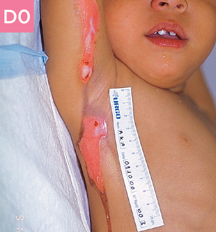 Small child wound before using UrgoTul
