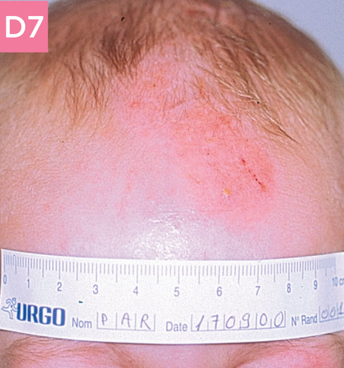 Small child with head wound after using UrgoTul