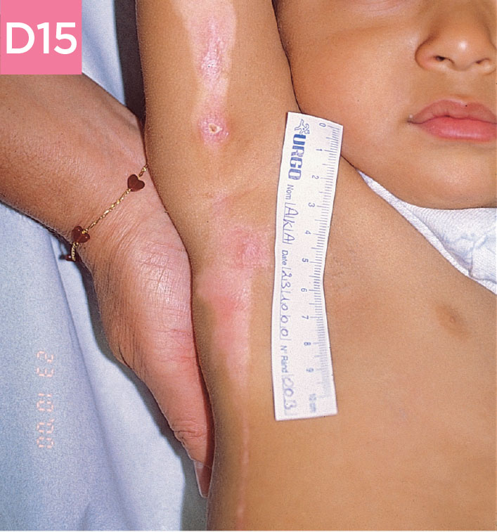 Small child wound before after using UrgoTul