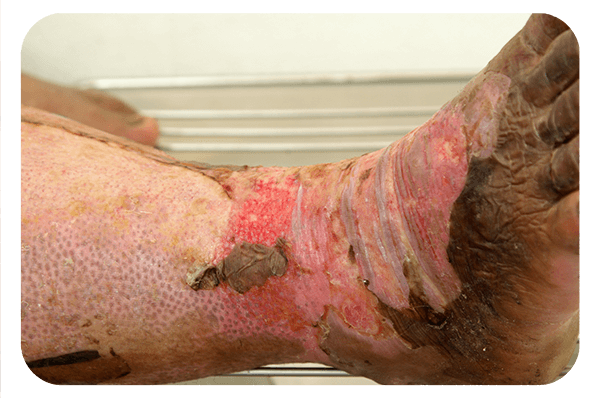vashe wound solution being used on a burn