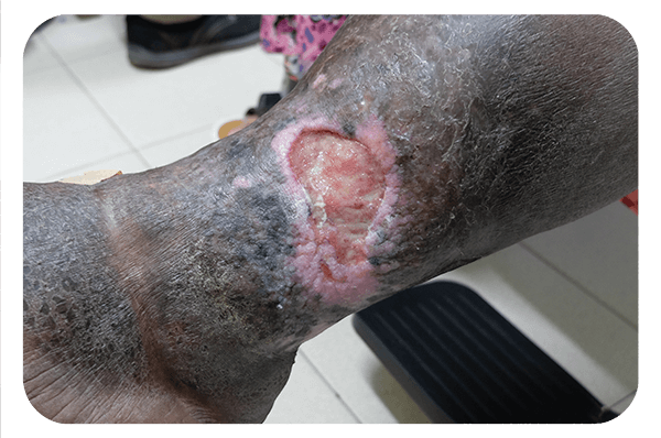 vashe wound solution being used on a venous leg ulcer