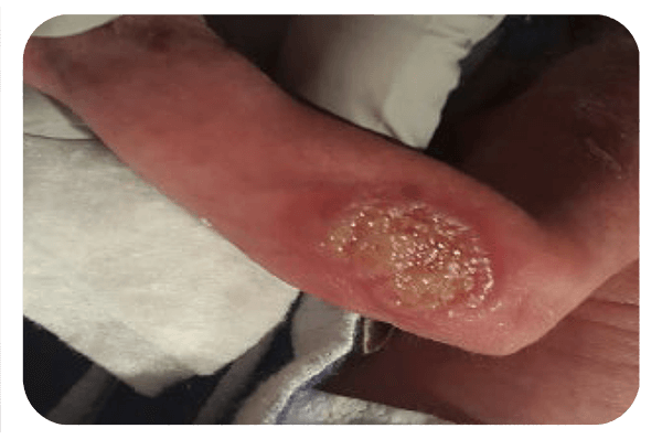 Vashe wound solution for pediatric use