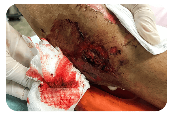 trauma wound