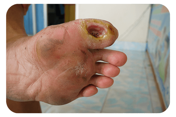 vashe wound solution being used on a diabetic foot ulcer