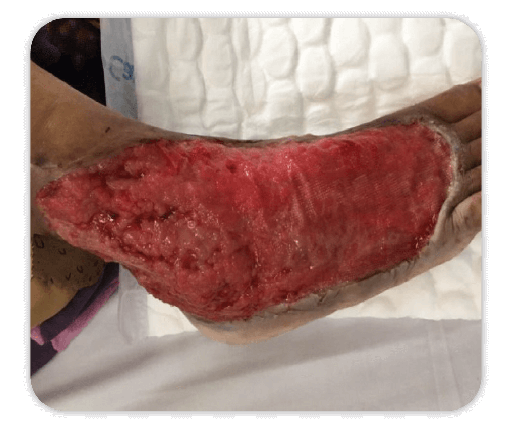 a clean wound after using urgoclean ag