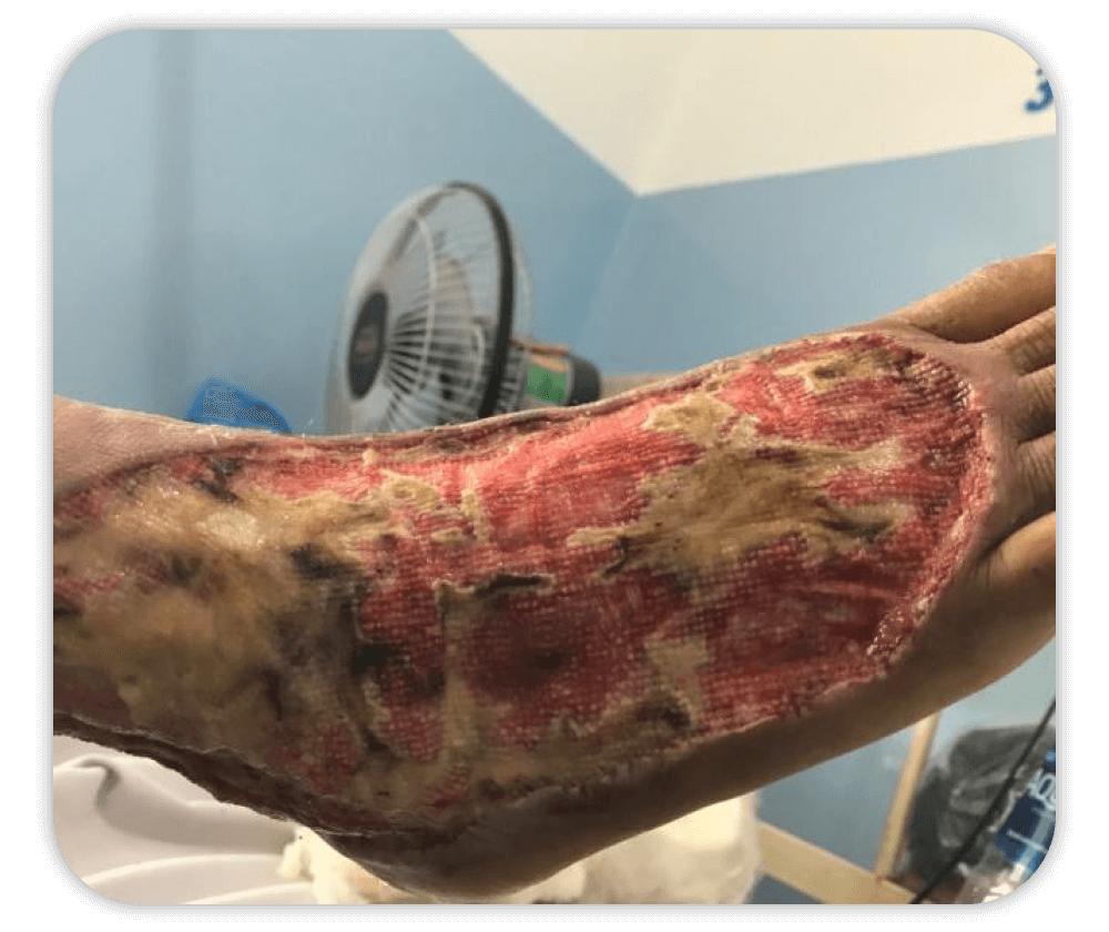 a wound on a foot before using urgoclean ag