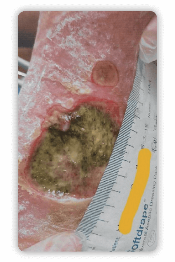 an ankle wound before using urgoclean ag