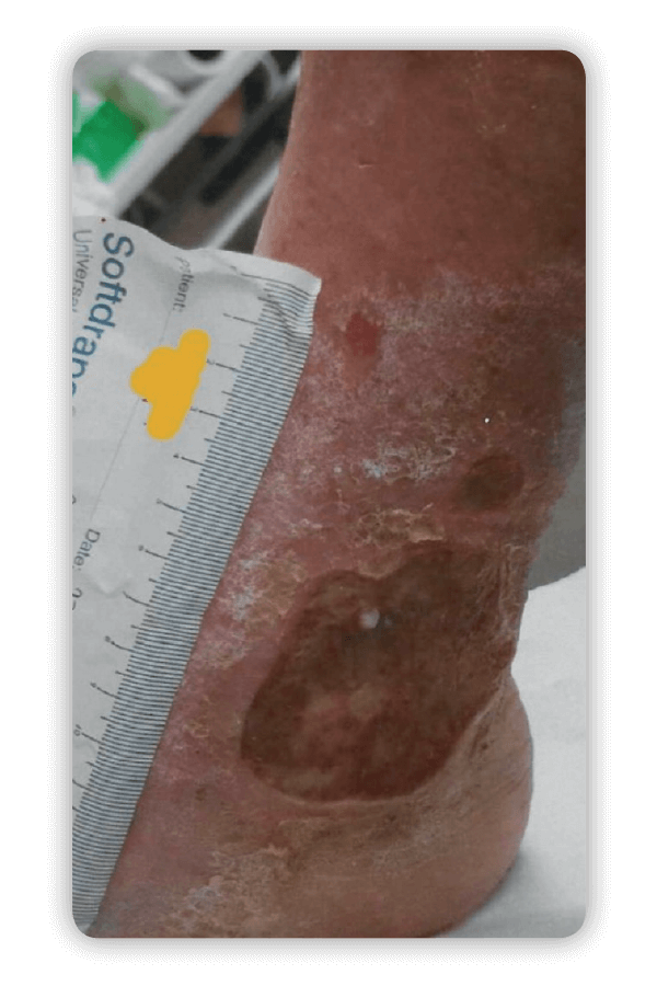 a clean ankle wound after using urgoclean ag