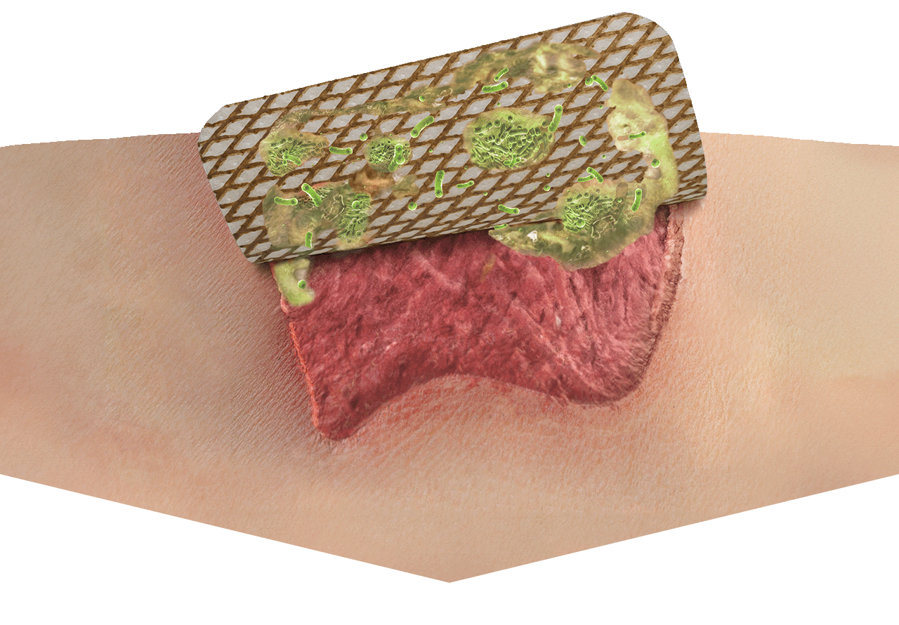 UrgoClean Ag in action, showing slough and debris removed from a wound.
