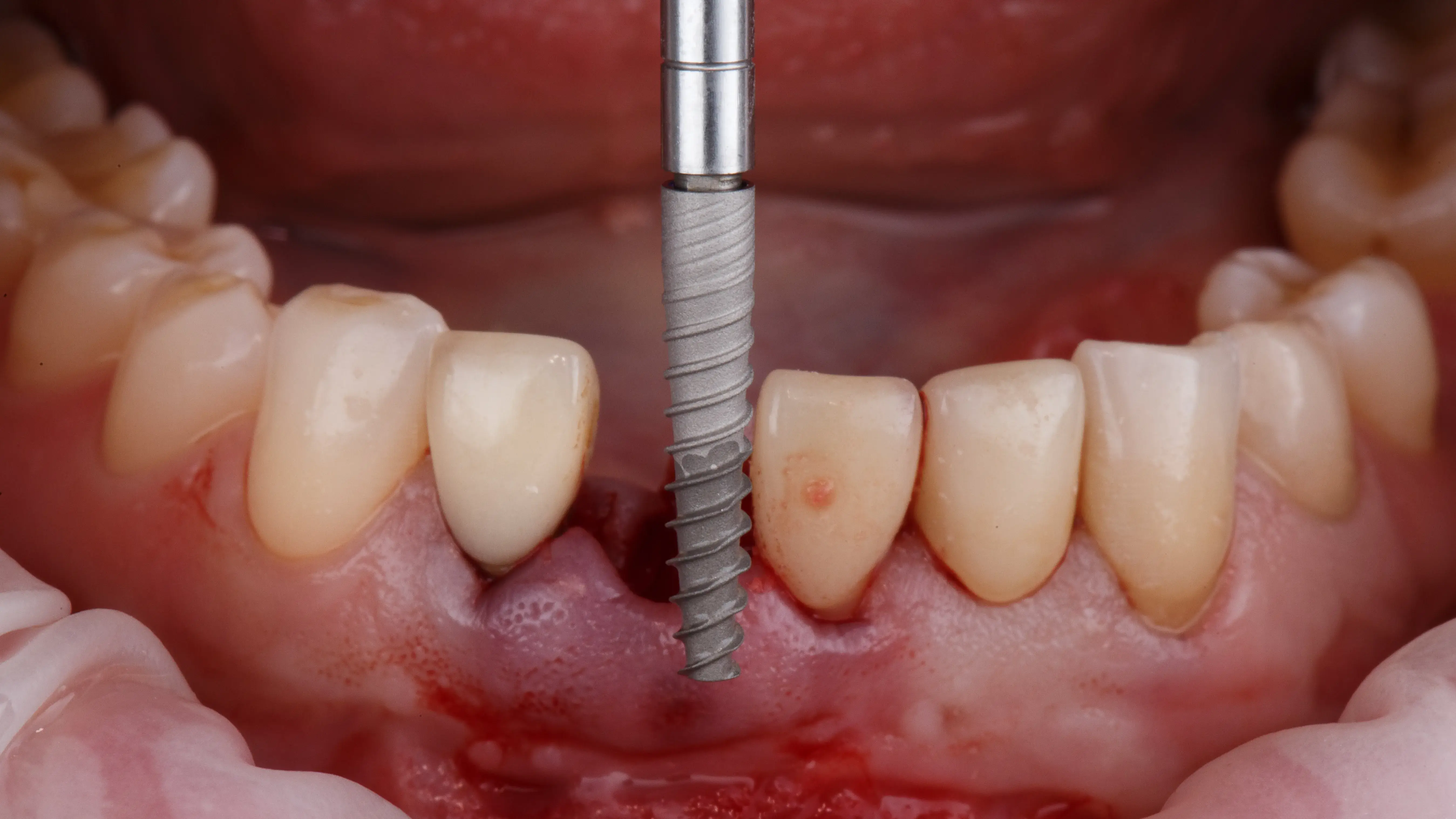 dlugi-implant-zebowy