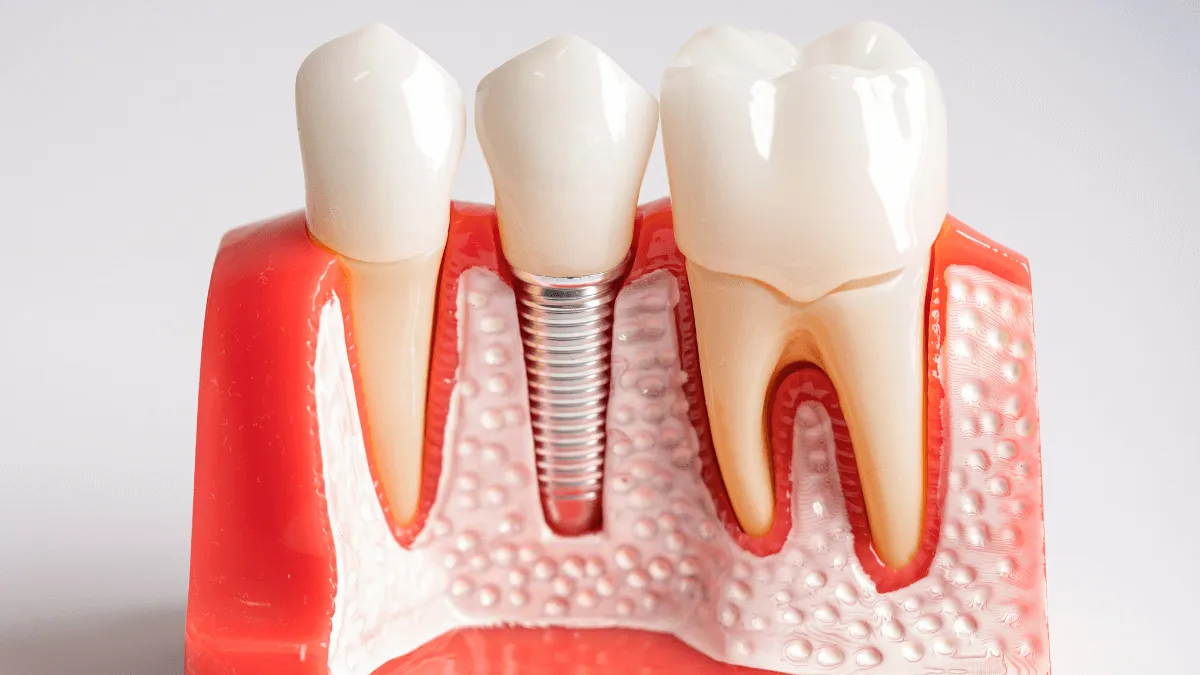 implanty-zebowe-a-osteointegracja