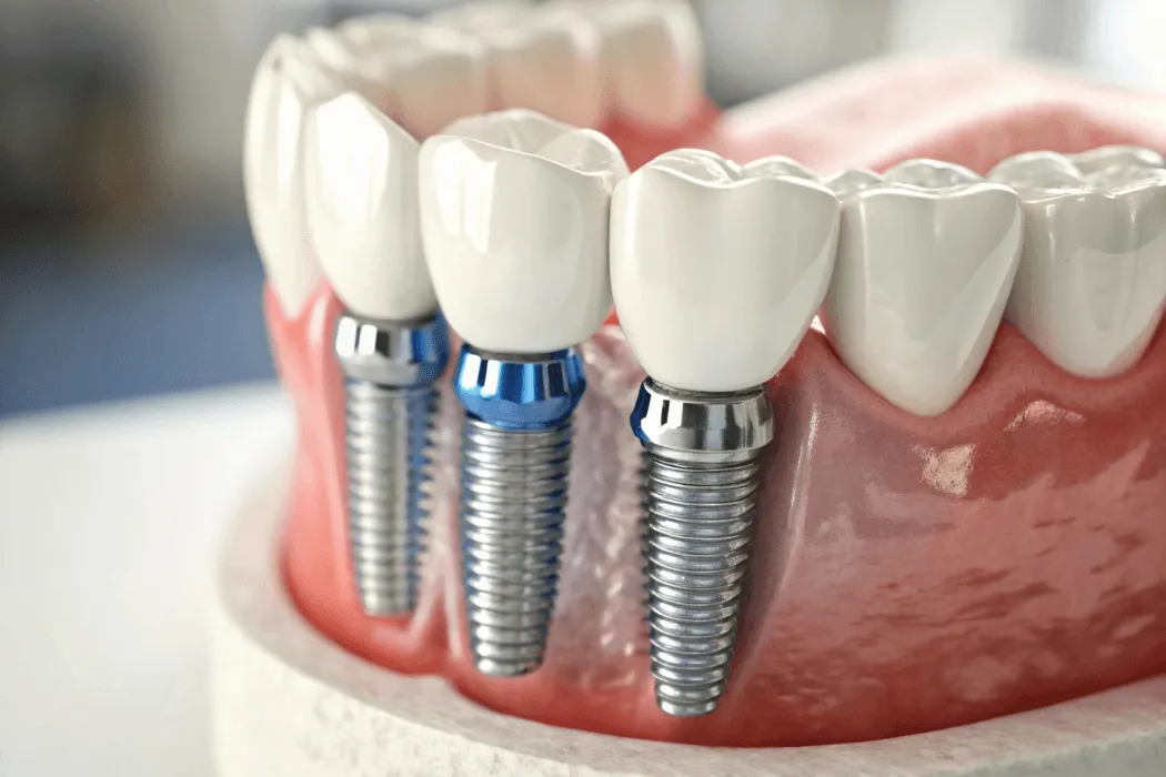 jak-dlugo-trwa-zabieg-wszczepienia-implantu