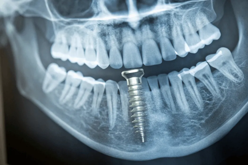 gojenie-implantow-zebowych-czas