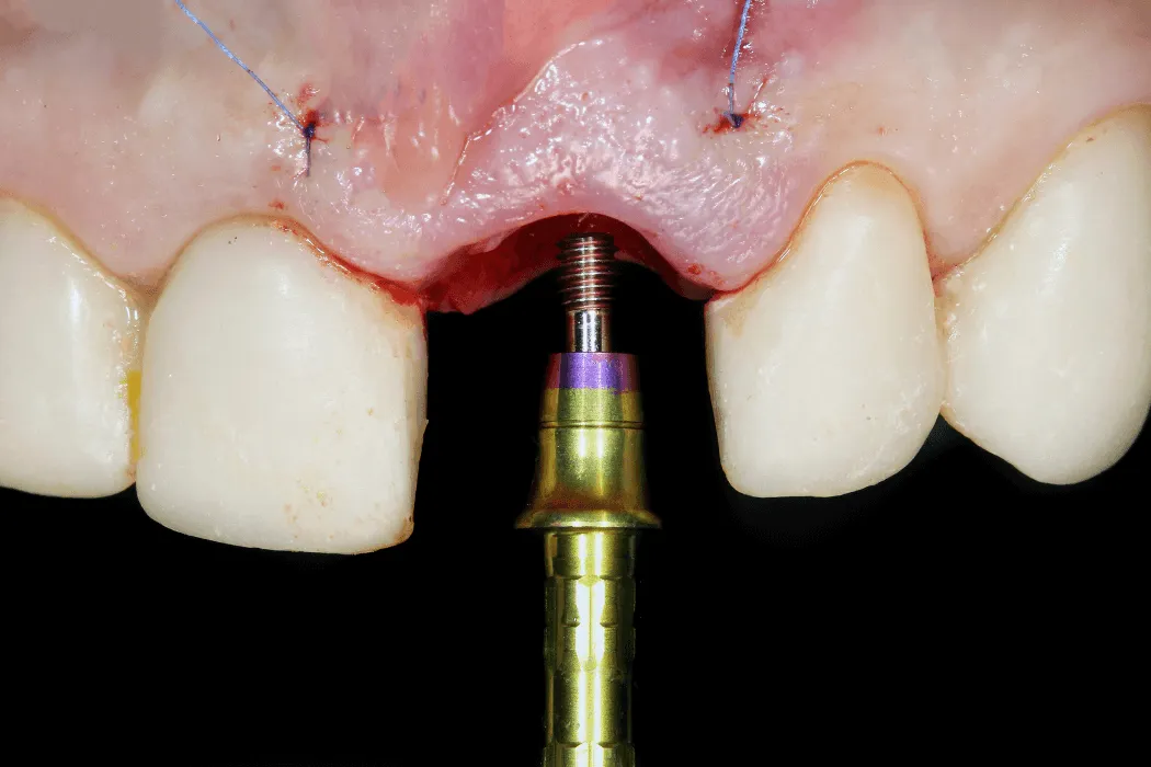 bakterie-wokol-implantu-zebowego