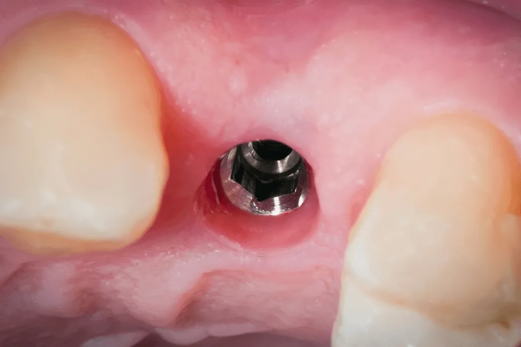 zapalenie-dziasla-wokol-implantu