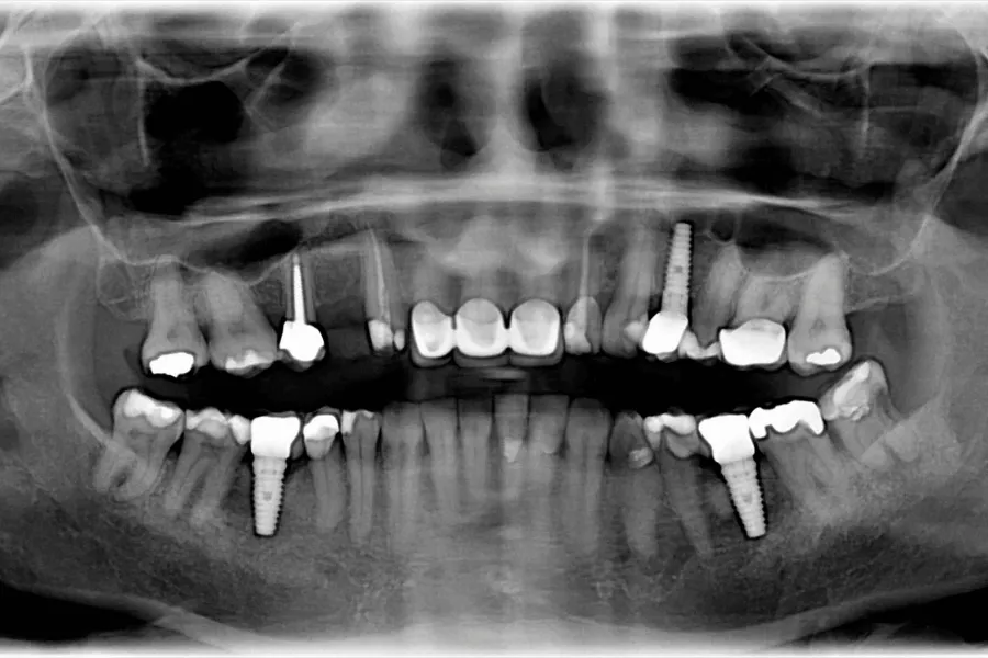 porownanie-zdrowych-tkanek-i-mucositis