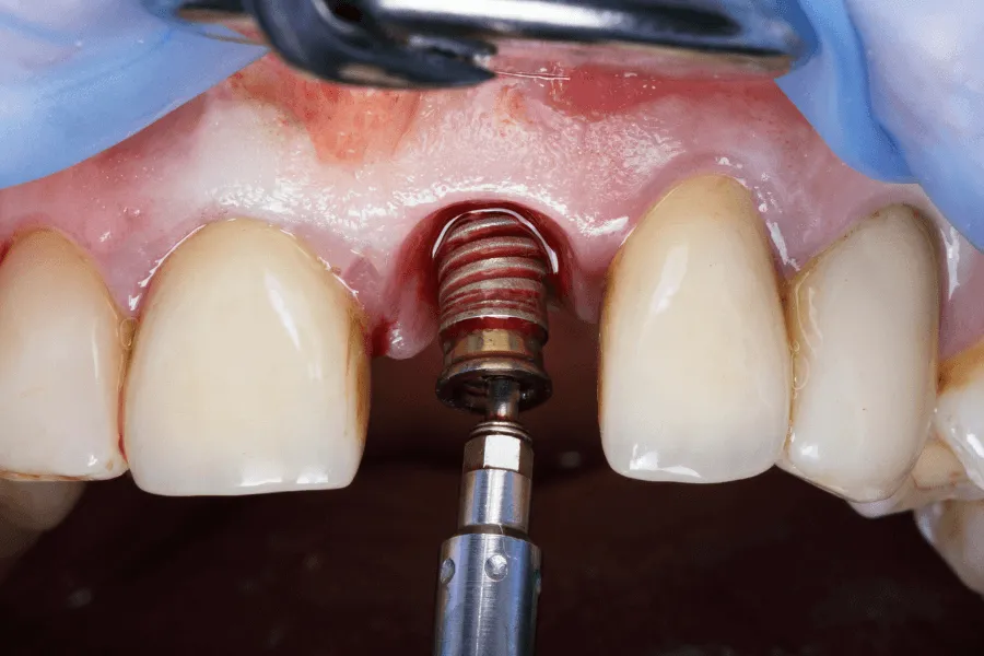 higiena-implantow-przy-mucositis