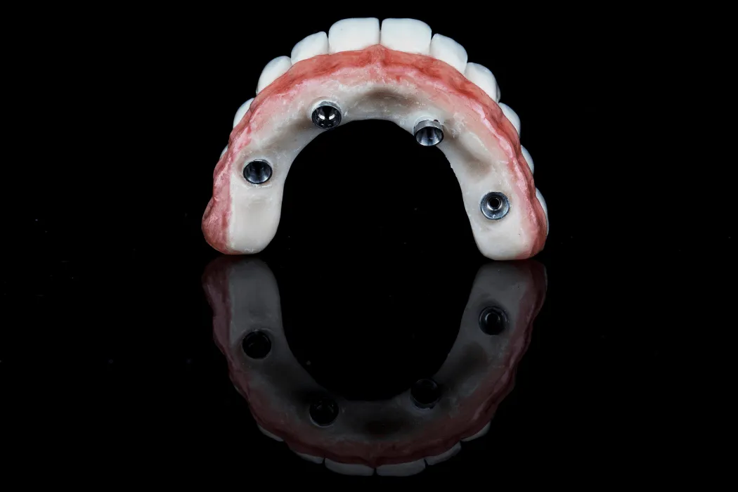 overdenture-stabilna-proteza-na-implantach