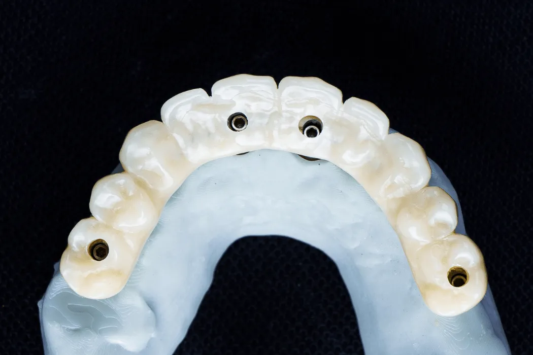 proteza-overdenture-poprawa-komfortu-zucia