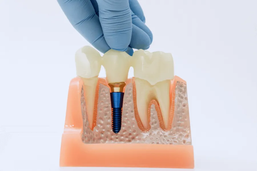 implant-z-korona-protetyczna