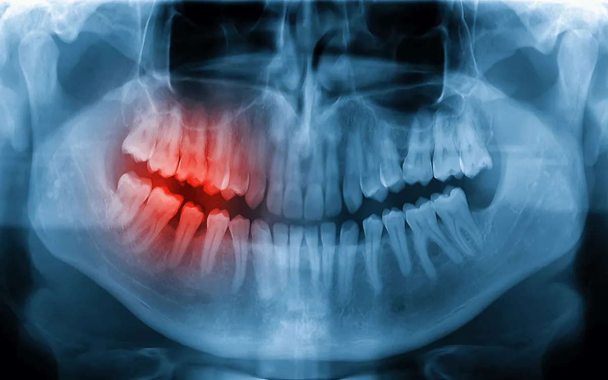 stan-zapalny-wokol-implantu-zeba-jak-wyglada-leczenie