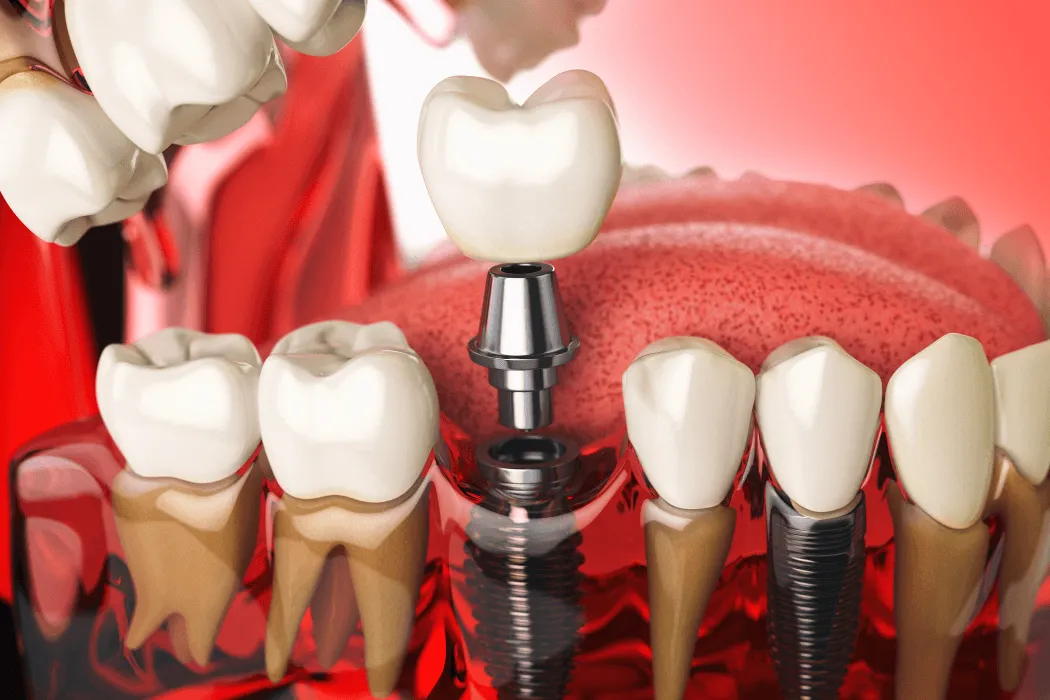 czy-kazdy-moze-miec-implant-zeba