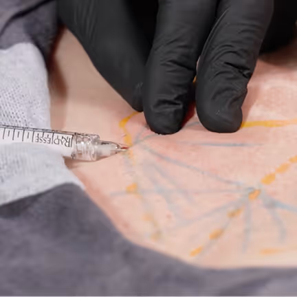 Nahaufnahme einer Injektion mit einer Spritze in die Haut, mit markierten Linien für Gesichtsbehandlung.