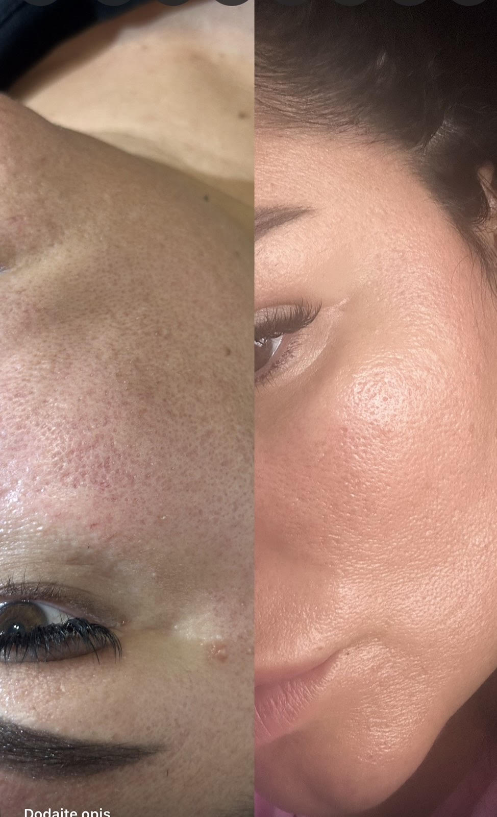 Skin pen rezultati pre i posle