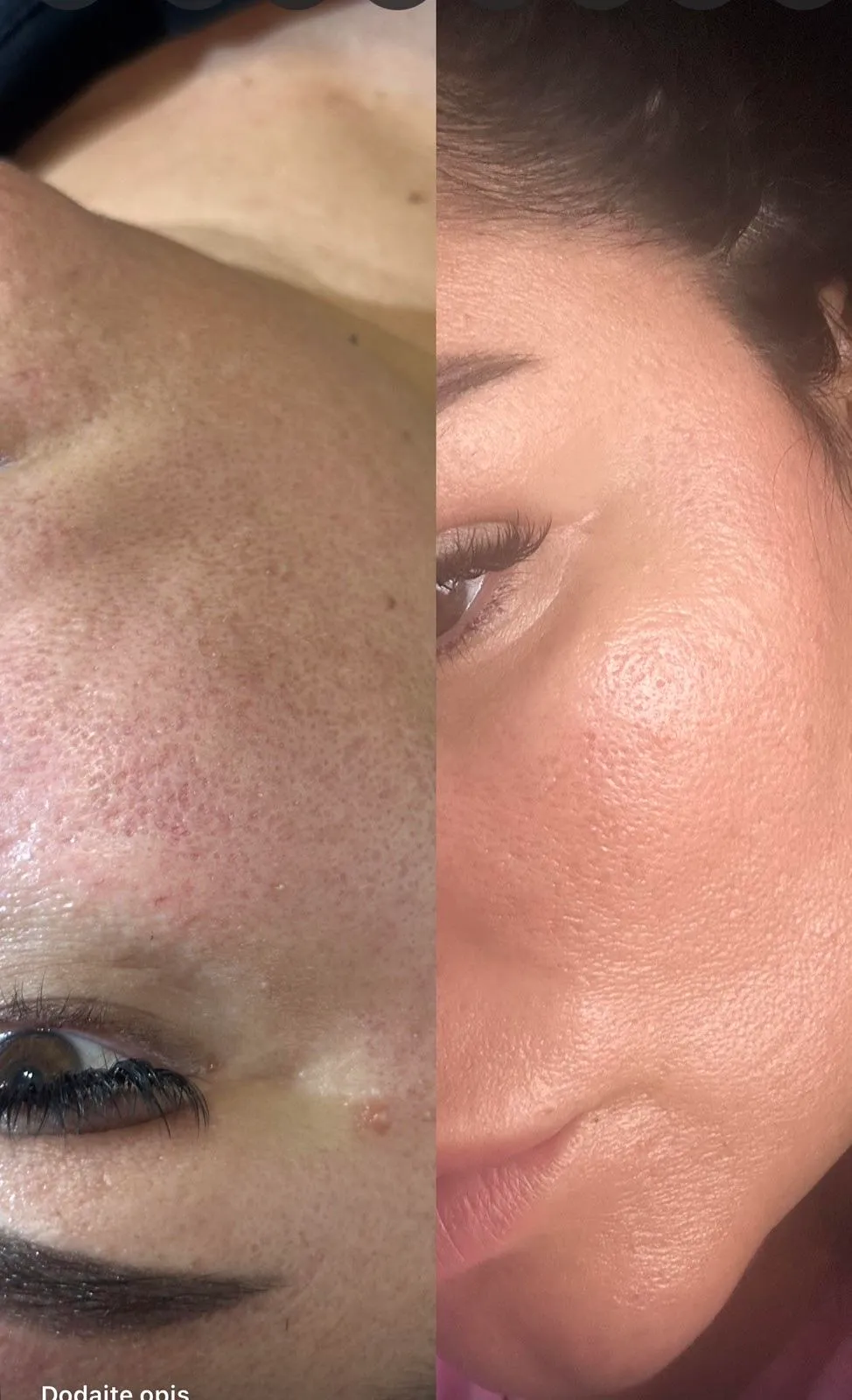 Skin pen rezultati pre i posle