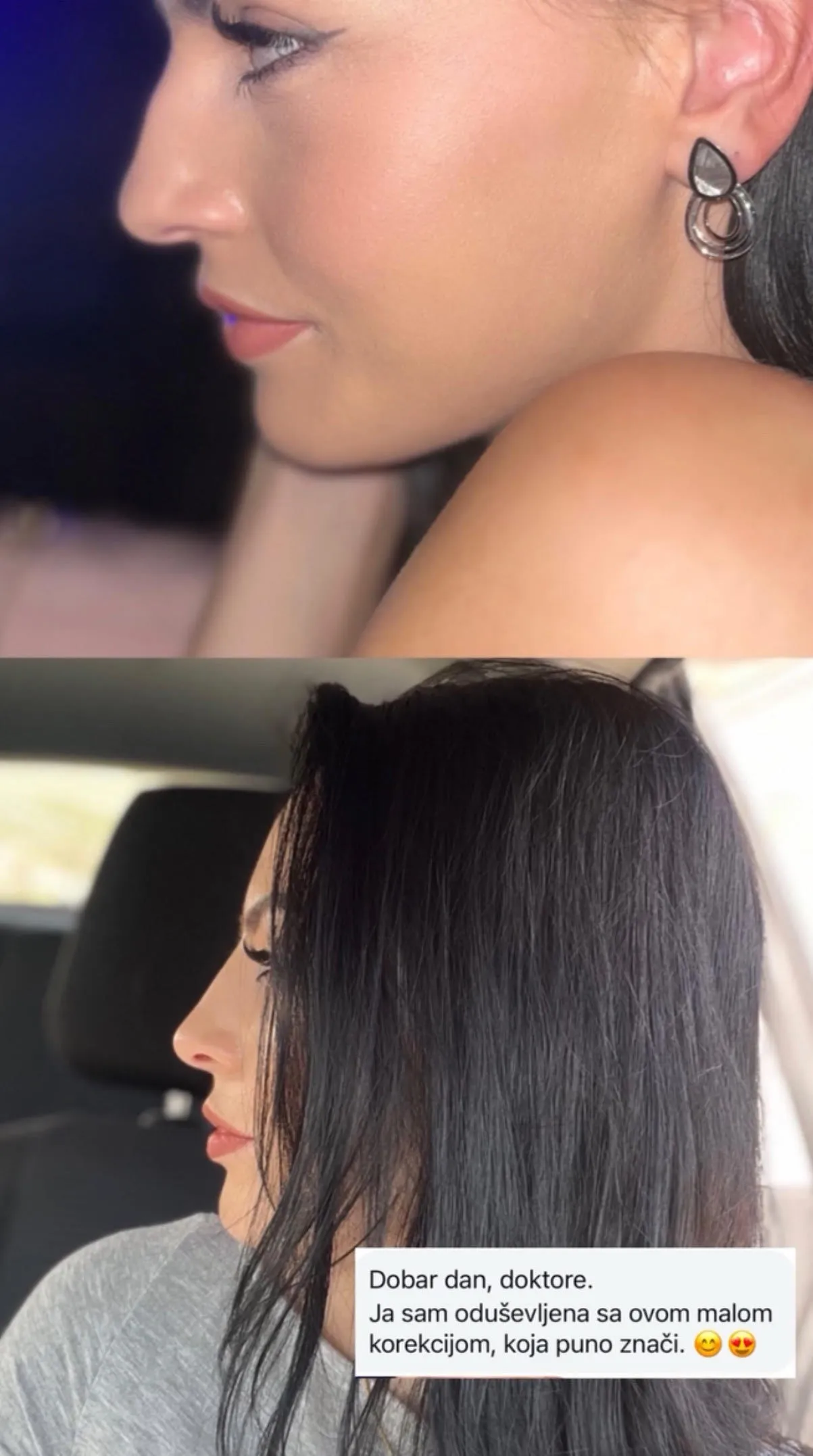 Korekcija nosa pre i posle rezultati