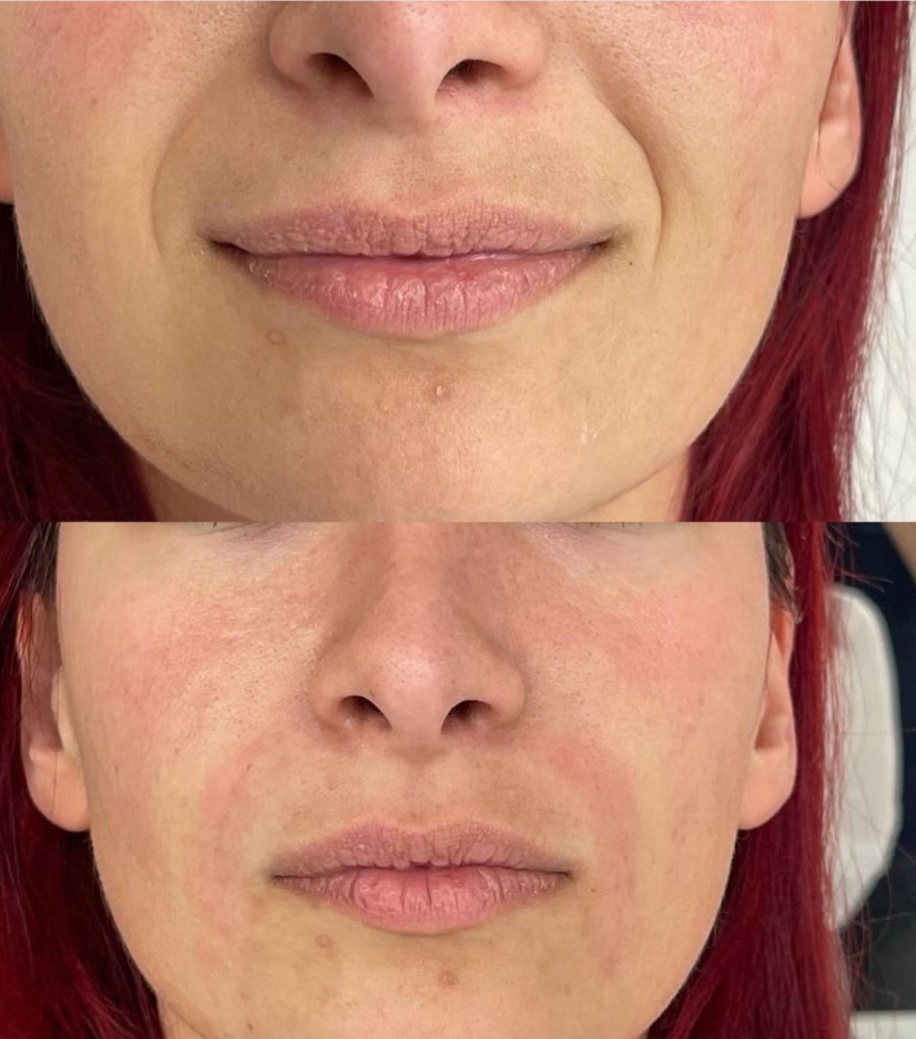 Korekcija nazolabijalnih bora