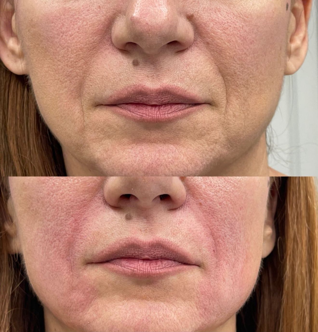 Korekcija nazolabijalnih bora pre i posle